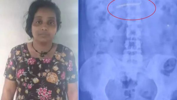 தங்கத்தை லபக்னு வாயில் போட்டு விழுங்கிய பெண்.. எக்ஸ்ரேவில் அந்த அதிசயம்.. பெரிய ட்விஸ்ட் பாருங்க