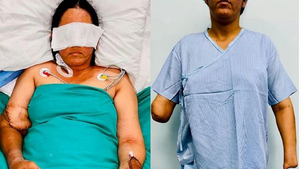 வரலாற்று வெற்றி டெல்லியில்.. கைகளை இழந்த பெண் மறுபிறவி அதிசயம்! மெய்சிலிர்க்க வைத்த ஆபரேஷன்