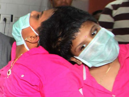 విడదీస్తారా?: 'త్వరలో ఢిల్లీ ఎయిమ్స్‌కు వీణా-వాణిలు'