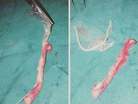 బాయ్‌ప్రెండ్‌తో సెక్స్: అనుకోకుండా కండోమ్ మింగేసింది