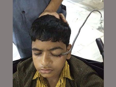 ఉస్మానియా వైద్యుల ఘనత: కంట్లోకి దూసుకెళ్లిన ఐరన్ హుక్ తొలగింపు