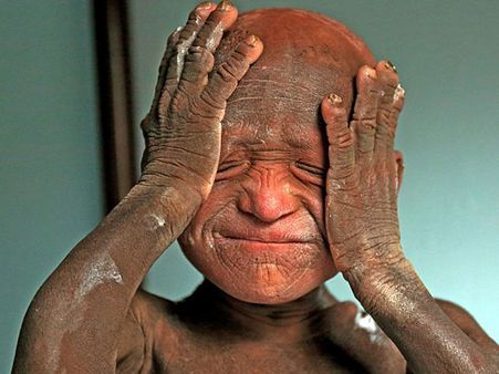 నేపాల్‌లో వింత: రాయిలా మారుతున్న బాలుడు (ఫోటోలు)