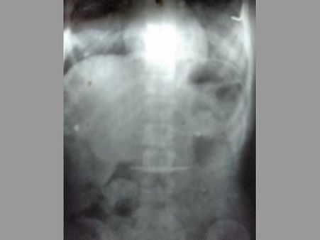 కత్తిని మింగిన మహిళ: ఆపరేషన్ చేసి బయటకు తీశారు (ఫోటోలు)