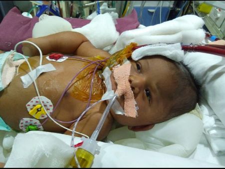 కిమ్స్-హైదరాబాద్ వైద్యుల ఘనత, శిశువుకు నియోటనల్ ఈసీఎంవో