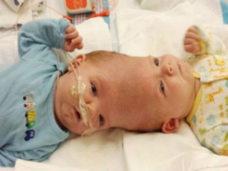 వీణా-వాణిల విషయంలో సాధ్యపడనిది.. అక్కడ మాత్రం సక్సెస్