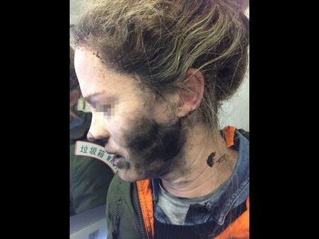 విమానంలో పేలిన హెడ్‌ఫోన్స్: కాలిపోయిన యువతి మొహం