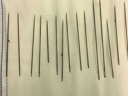 శరీరంలో 100కి పైగా సూదులు: స్కానింగ్ రిపోర్టు చూసి డాక్టర్ల షాక్..