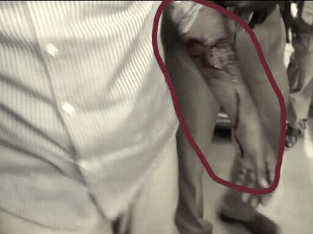 నకిలీ నోట్లు చలామణి ముఠా అరెస్ట్: అవమానంతో చేతిని బ్లేడుతో కోసుకున్న నిందితుడు