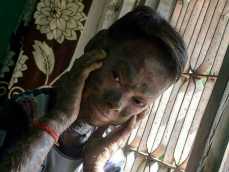 మానవ 'పాము'! ప్రతి నలభై ఐదు రోజులకు ఒకసారి కుబుసం విడుస్తున్న బాలిక!