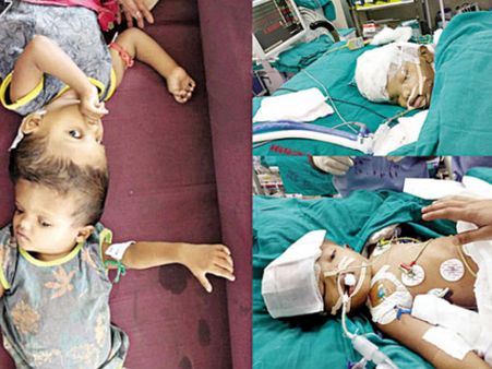 ఒడిశా అవిభక్త కవలలను విడదీశారు: మరి వీణా-వాణీల పరిస్థితి ఏంటి?