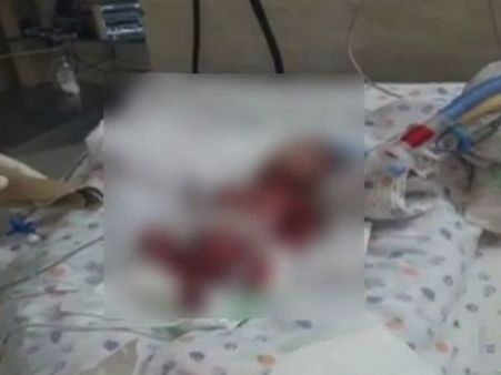 సంచీలో మృత కవలలను ఇచ్చిన ఆస్పత్రి: ఒక్కరు సజీవమే