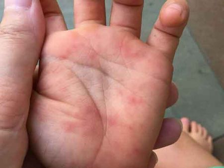 గుంటూరులో పెరుగుతున్న వైరల్ ఇన్ఫెక్షన్లు:ఈ నగరానికి ఏమైంది?...