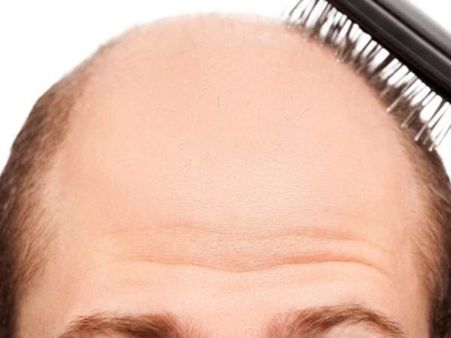 తస్మాత్ జాగ్రత్త: హెయిర్ ట్రాన్స్‌ప్లాంట్ తర్వాత వ్యక్తి మృతి... వైద్యం ఎందుకు వికటించింది..?