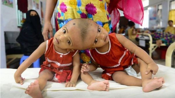 30 గంటలు..35 మంది వైద్యులు: అవిభక్త కవలలను వేరు చేసిన హంగేరీ డాక్టర్లు