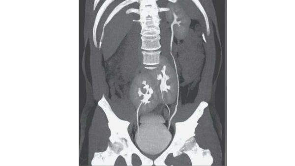ఇదేం వింత: వెన్నునొప్పితో హాస్పిటల్‌కు వెళ్లిన వ్యక్తికి కొత్త సమస్య..ఏంటో తెలిస్తే షాకే..!