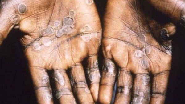 మంకీ పాక్స్ ఎలా వస్తోంది.. లక్షణాలు ఏంటీ, చికిత్స ఎలా..?