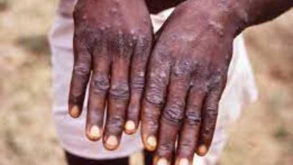 అమెరికాలో బయటపడ్డ అరుదైన 'మంకీ పాక్స్'... గడిచిన 20 ఏళ్లలో ఇదే తొలి కేసు...