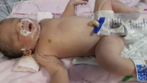 శ్వాస తీసుకోవడంలో ఇబ్బంది పడుతున్న చిన్నారి.. మీ విరాళాలే కాపాడుతాయి..!!