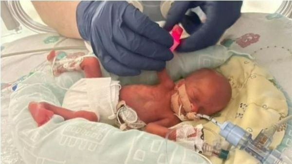 20 ఏళ్ళ తర్వాత యూకేలో అతి చిన్న శిశువు జననం; బరువు అరకిలోకు తక్కువే!!