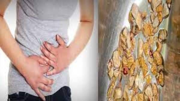 206 రాళ్లు తీసేశారు.. సిటీలో రేర్ ఆపరేషన్, సమ్మర్‌లో ఇలా చేయాలంటూ డాక్టర్స్ సజెషన్