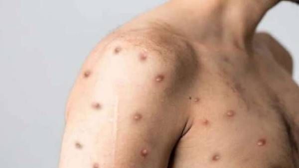 పశ్చిమబెంగాల్‌లో మంకీపాక్స్ కలకలం: దద్దుర్లు, లక్షణాలతో ఆస్పత్రిలో చేరిన కోల్‌కతా విద్యార్థి