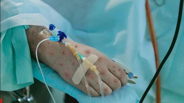 మంకీపాక్స్ మహమ్మరి: అంతర్జాతీయ ఆరోగ్య అత్యయిక పరిస్థితి: డబ్ల్యుహెచ్‌వో ప్రకటన