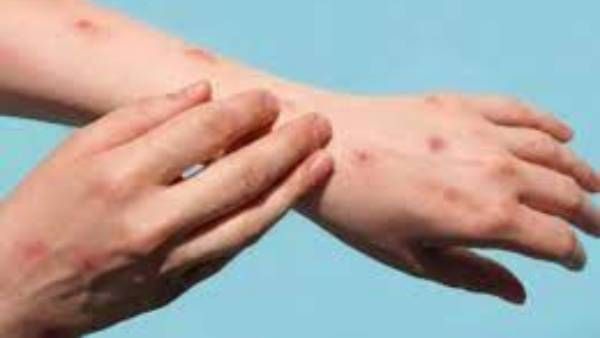 5లో 3 కేసులు సెక్సువల్ కాంటాక్ట్.. 2 కేసులు నో: మంకీపాక్స్‌పై ఐసీఎంఆర్ అధ్యయనం