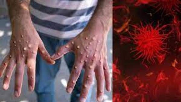 కట్టు తప్పుతున్న మంకీపాక్స్: ఆ రాష్ట్రాల్లో కలకలం