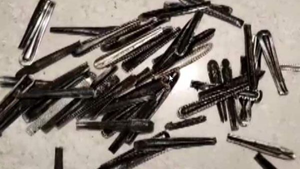 కడుపులో నొప్పి అని ఆస్పత్రికి.. ఆపరేషన్ చేసి 62 స్టీల్ స్పూన్లు తీసిన డాక్టర్!