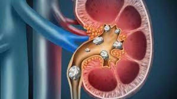 Stones in Kidneys: రాళ్లు కిడ్నీల్లోనే కాదు.. శరీరంలోని ఇతర భాగాల్లో కూడా..