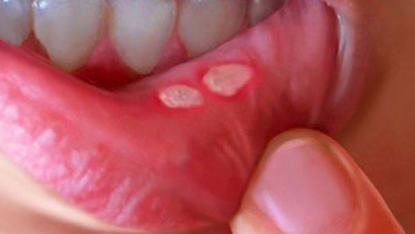  health tips: నోటిపూతకు కారణాలు.. తగ్గటానికి నేచురల్ రెమిడీస్!!