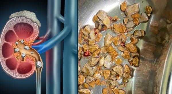 కిడ్నీనా .. రాళ్ళ గనినా? మూత్రపిండంలో 3వేల రాళ్ళు వెనకేసిన ఏపీ వాసి..తొలగించిన వైద్యులు!!