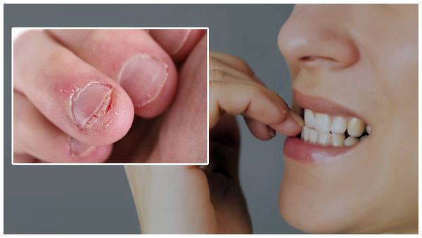 Health tips: గోళ్ళు కోరికే అలవాటు మానలేకపోతున్నారా? ఈ చిట్కాలు ట్రై చెయ్యండి!!