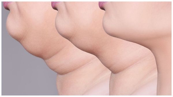 Health tips: ముఖాన్ని అందవిహీనం చేసే డబుల్ చిన్ సమస్య: తగ్గించుకోండిలా!!