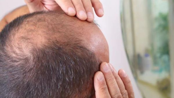  health tips: జుట్టుకు శత్రువులు ఈ ఆహారాలు; వీటితో బట్టతలకు ఛాన్స్!!