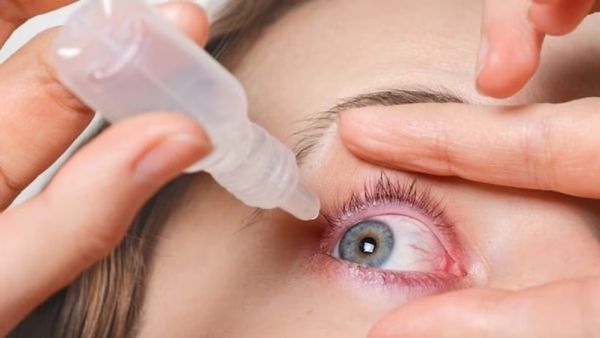 Conjunctivitis: దేశవ్యాప్తంగా పెరుగుతోన్న కళ్లకలక కేసులు..