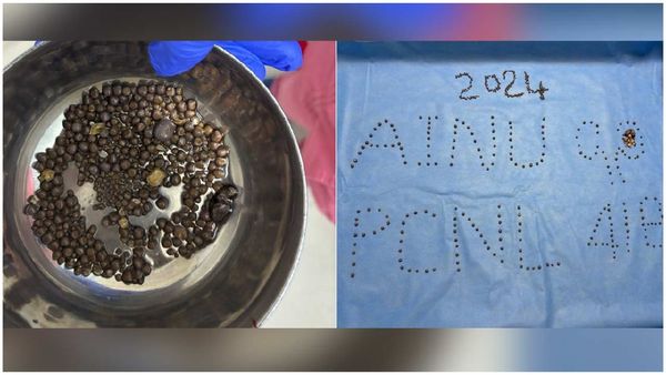 418 రాళ్ళు వెనకేసుకున్న వ్యక్తి.. కిడ్నీలో రాళ్ళు తొలగించిన వైద్యులే షాక్!!