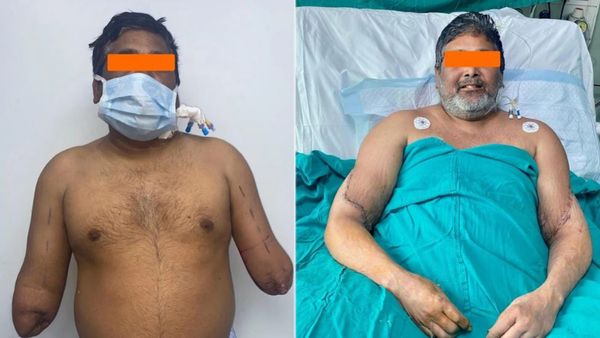 Hand Transplantation: పురుషుడికి మహిళ చేతులు అమరిక..