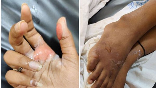 స్నానం చేసే బకెట్‌లో యాసిడ్!: ఇక్ఫాయి వర్సిటీలో విద్యార్థినికి తీవ్రగాయాలు