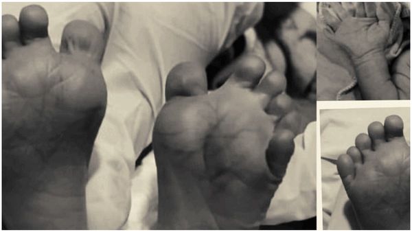 క‌ర్ణాట‌క‌లో వింత‌.. 25 వేళ్ల‌తో శిశువు జ‌న‌నం..