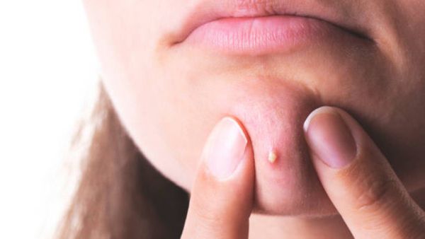 మొటిమలు గిల్లుతున్నారా..?అయితే జరిగేది ఇదే..!