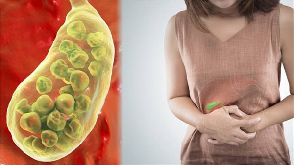 Gallbladder: గాల్‌బ్లాడర్‌లో స్టోన్స్‌ ఎందుకు ఏర్పడతాయి..? సర్జరీ తప్పనిసరా..?