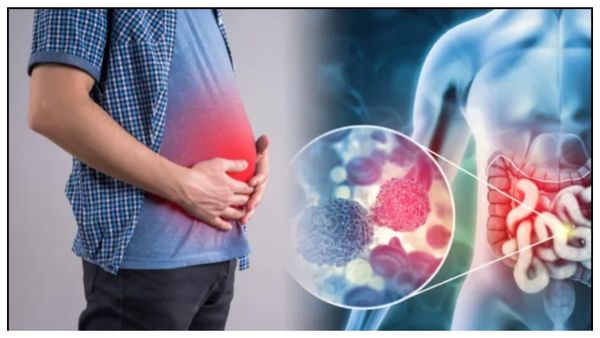 Prostate Cancer: పురుషులకు ప్రాణసంకటంగా ప్రొస్టేట్ క్యాన్సర్.. ప్రతి 8 మందిలో ఒకరికి ఛాన్స్