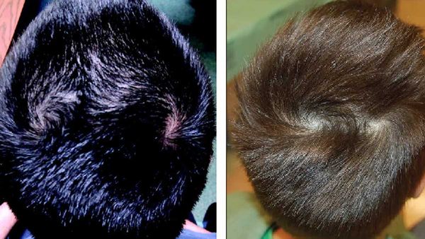 తలలో రెండు సుడులు ఉంటే రెండు పెళ్లిళ్లు అవుతాయా? దీనిలో నిజమెంత?