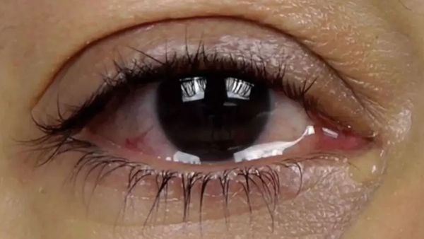 చలికాలంలో కళ్లమ్మట నీళ్లు కారుతుంటే ఇది తెలుసుకోండి