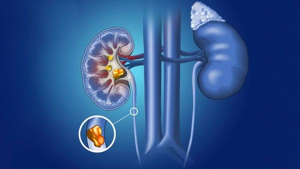 కిడ్నీలో రాళ్లను కరిగించే మొక్క.. రూపాయి ఖర్చు లేకుండా ఇలా ట్రై చేయండి.