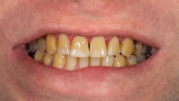 దంతాలు గార పట్టి పసుపు కలర్‌లో మారాయా? ఇలా ట్రై చేయండి మిల మిల మెరుస్తాయి!