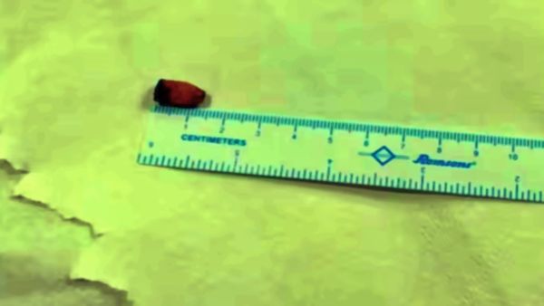 21 ఏళ్లుగా ఊపిరితిత్తుల్లో ఇరుక్కుపోయిన పెన్ క్యాప్‌.. వైద్యుల మైండ్ బ్లాంక్..