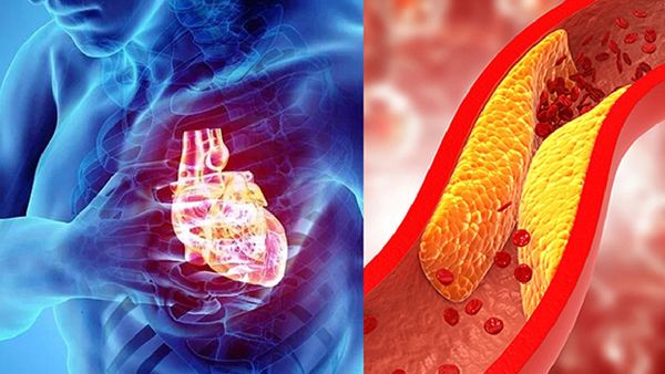 చెడు కొలెస్ట్రాల్ తగ్గించే ఆయుర్వేద చిట్కాలు!