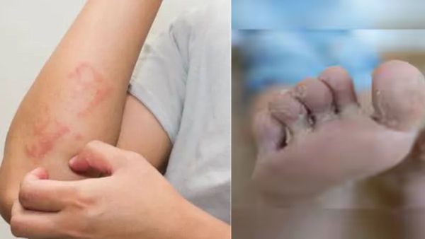 వర్షాకాలంలో చర్మ సమస్యల విషయంలో నిర్లక్ష్యం వద్దు!